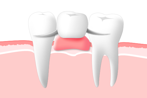 入れ歯の種類