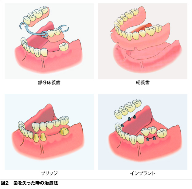 【ブログ】歯周病が全身に及ぼす影響