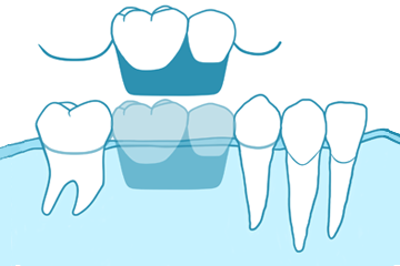 【 ブログ 】教えて、インプラント治療ってなに？　　　｜入れ歯やブリッジとの違いは